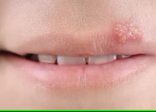Cold Sores